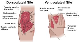 Ventrogluteal-and-Dorsogluteal-IM-Injection-Site.jpg