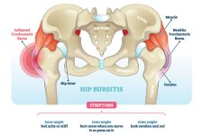 hip-bursitis-inflamed.jpg